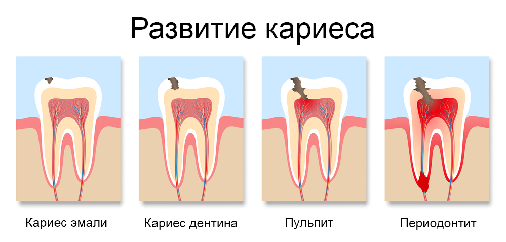 Развитие кариеса